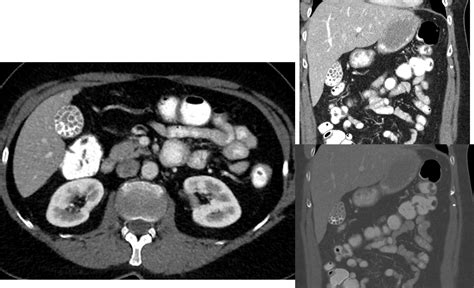 Radiology Case - Occasional RUQ Pain after Eating [clinical] : r ...