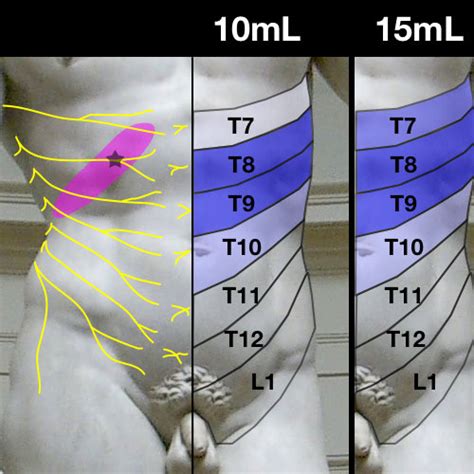 Pdf Ultrasound Guided Subcostal And Midaxillary Transverses Abdomens