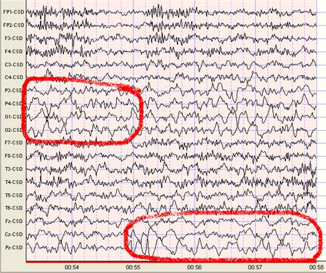 Delta Waves - Scottsdale Neurofeedback Institute, AZ