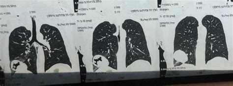 CECT revealed large cavitary lesion involving the right lower lobe with... | Download Scientific ...