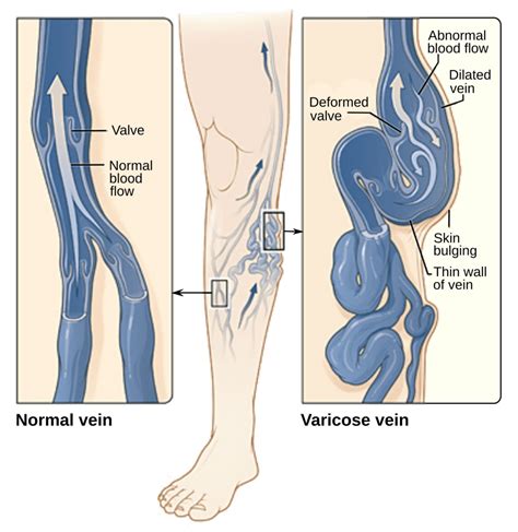 Varicose Veins Center For Advanced Cardiac And Vascular Interventions