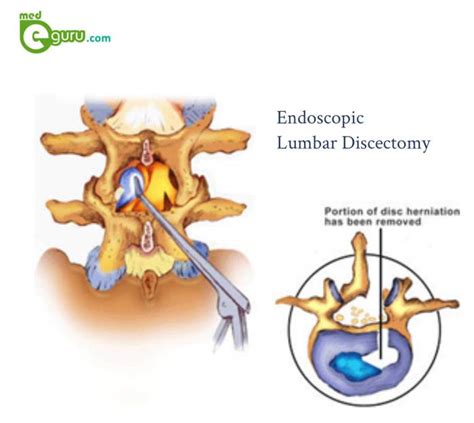 Lumbar Discectomy