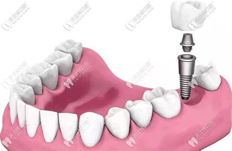 全国种植牙价格表种植牙价格表 种植体价格表与材料 开立特口腔