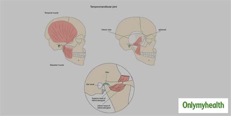 What Is TMJ Syndrome? Here Are Its Symptoms, Causes, Treatment And Side-Effects | OnlyMyHealth