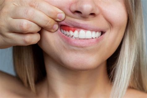 Qué son las encías retraídas Clínica Dental Vallina