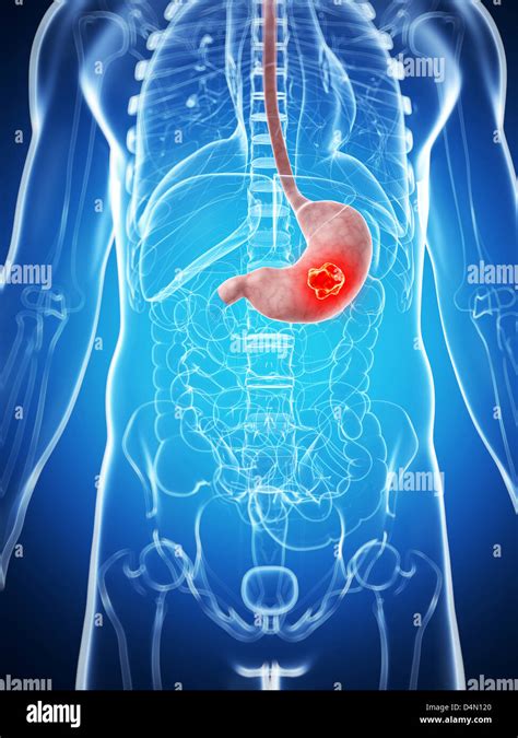 Stomach Cancer Stock Photo Alamy