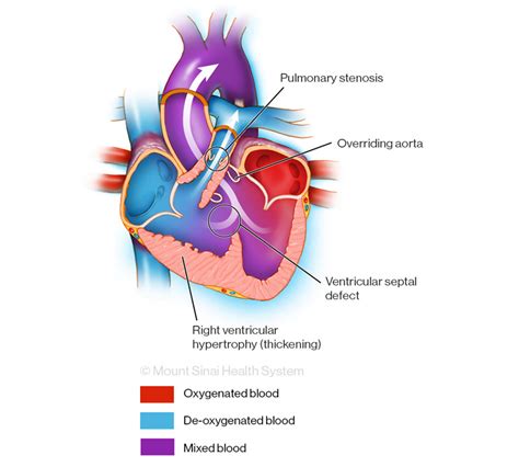 Tetralogy Of Fallot TOF Diagnosis Treatments Mount Sinai New York