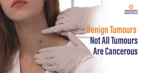 understanding benign tumours   tumours  cancerous