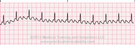 Ekg Artifacts Dysrhythmias Injury And Analysis Flashcards Quizlet