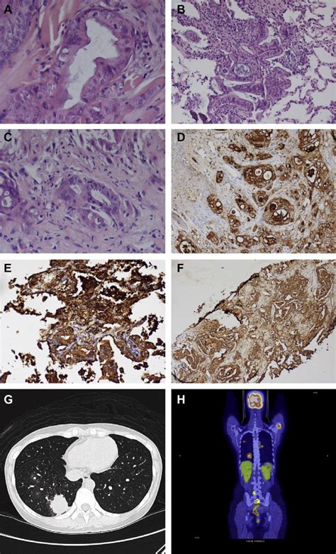 Characteristic Pathological Pictures Of Apocrine Carcinoma With