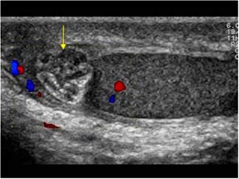 Normal Epididymis Ultrasound