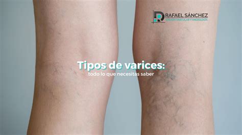 Tipos de varices todo lo que necesitas saber Doctor Rafael Sánchez