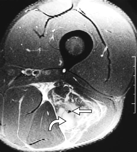 Hamstring Muscle Complex An Imaging Review Radiographics