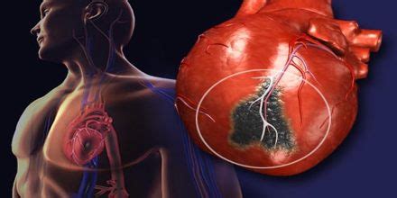 Lecture on Heart Disease - Assignment Point