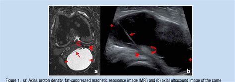 Figure From Treatment Of Popliteal Baker Cysts With Ultrasound