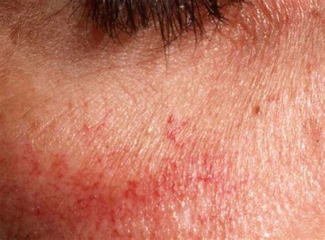 Types Of Rosacea Facial Redness Erythema—the Medical Term Flickr