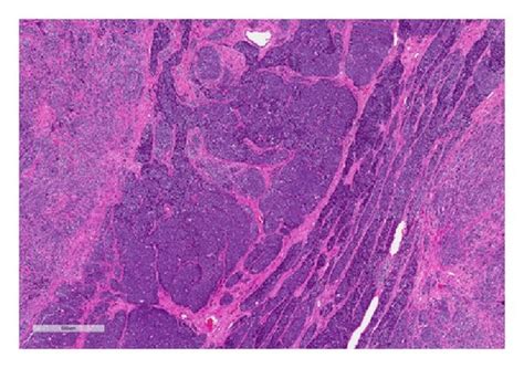 Testicular Granulosa Cell Tumor Histology Sections Of The Testis Show