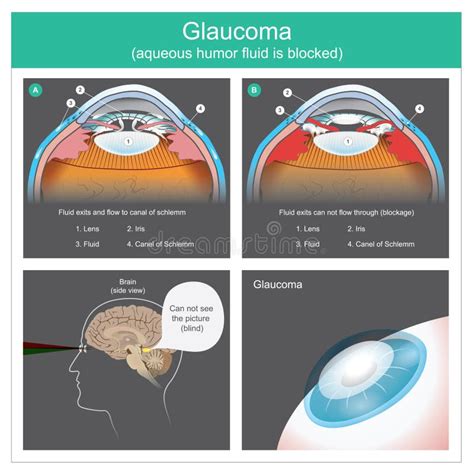 Glaucoma Del Ojo Humano Ilustración Del Vector Ilustración De Lente