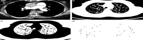 Prognostic Significance Of Small Pulmonary Vessel Alteration Journal Of Thoracic Imaging