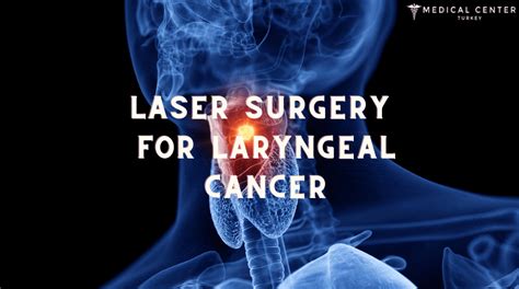 Laser Surgery For Laryngeal Cancer Mct