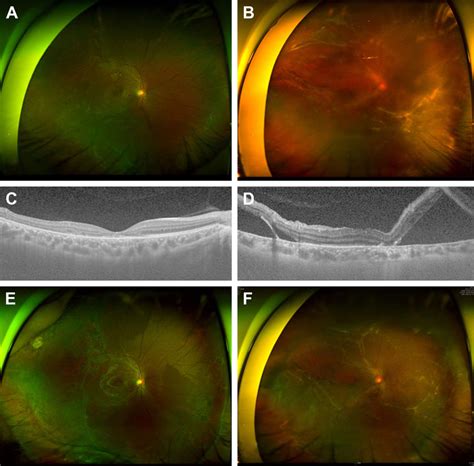 Chronic Rhegmatogenous Retinal Detachment With Subretinal Strand