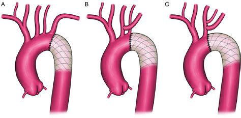 Figure 2 From Repair Of Complicated Type B Dissection With An Isolated