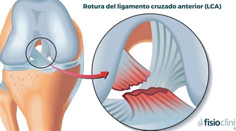 Tiempo De Baja Por Esguince Cervical Cu Nto Dura Realmente