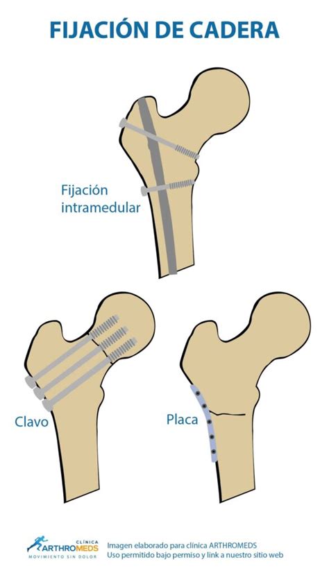 Tratamiento para fractura de cadera Lima Perú