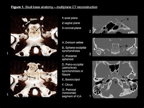 Figure 1 From Mri Characterization Of Skull Base Chordoma And Chondrosarcoma In A Patient