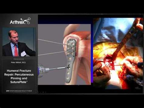 Humeral Fracture Repair Percutaneous Pinning And Sutureplate Youtube