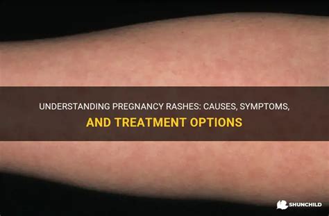 Understanding Pregnancy Rashes Causes Symptoms And Treatment Options