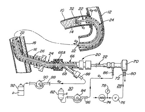 Coronary arteries patented technology retrieval search results - Eureka