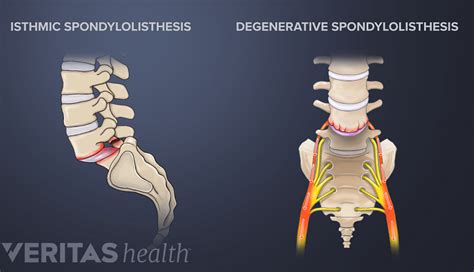 Isthmic Spondylolisthesis | Spine-health