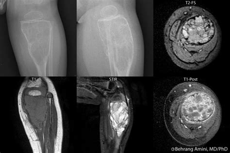 Roentgen Ray Reader: Aneurysmal Bone Cyst