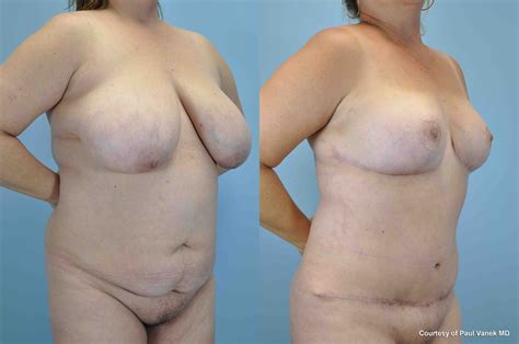 Breast Reduction Gallery Dr Paul Vanek