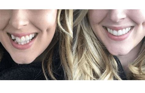 Invisalign Before and After: From Crooked to Confident - Oral Health Line