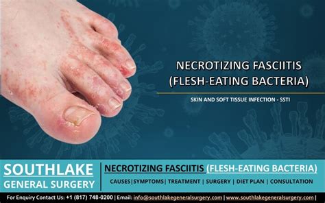 Laparoscopic Surgery Texas — Necrotizing Fasciitis Flesh Eating Bacteria