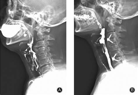 Zeroprofile Implant System For Treatment Of Dysphagia Caused By