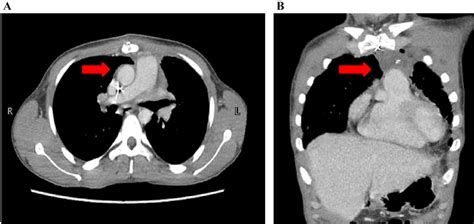 Figure From Mediastinal Seminoma In A Pediatric Patient Managed With