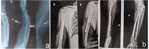 A Pre Op X Ray Shows Both Bone Fracture Of Three Parts And Midshaft