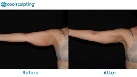 Coolsculpting Before and After Pictures - Female Arms