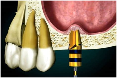 Sinus Augmentation – Lane Ends Dental Practice – Preston