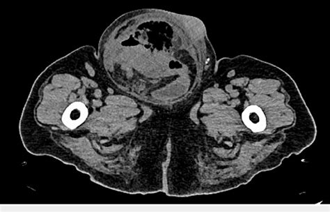 Figure 2 From A Rare Case Of Perforated Caecal Cancer Disguised As A