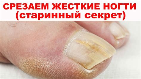 Как размягчить ногти на ногах чтобы легче подстричь у пожилых людей в ...