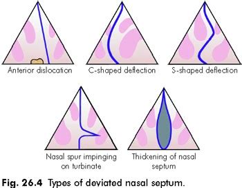 MEDICAL MNEMONICS: Types of DNS (Deviated Nasal Septum)