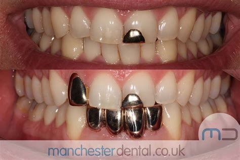 Gold Teeth Manchester Dental Implant Centre Cosmetic Dentistry Clinic