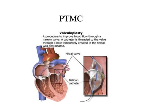 PPT - Balloon Mitral Valvuloplasty PowerPoint Presentation - ID:687186