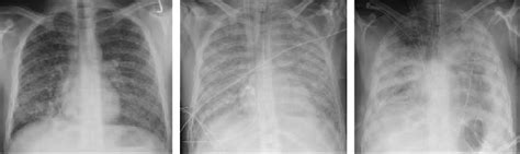 Clinical Manifestations and Treatment of Blastomycosis - Clinics in ...