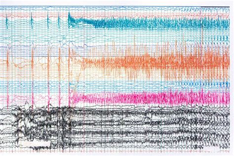 Photograph Of Ictal Eeg During Seizure Stock Image Image Of Ictal