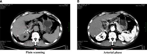 Frontiers A Large Ectopic Hepatocellular Carcinoma With Adrenal